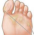 callus on foot