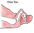 claw toe