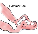 hammer toe