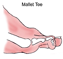 mallet toe